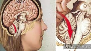 Brain Herniation or Herniation Syndrome [upl. by Eissahc]