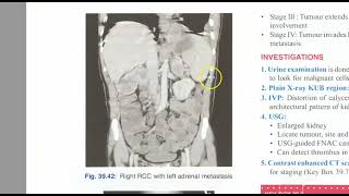 Surgery 953 Renal Cell Carcinoma Kidney Tumor TNM Staging Investigations Treatment [upl. by Aerdnaxela]