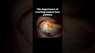 Contact Lens lost under eyelid eyes ophthalmology optometry [upl. by Malinin]