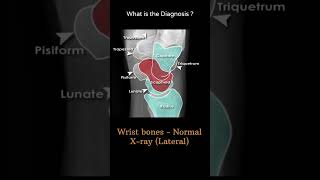 Wrist bones  Normal Xray lateral 88 Trauma Xray  Upper limb Wrist ‎radiologychannel007 [upl. by Areit617]