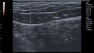 Superior cluneal nerve entrapement [upl. by Franciscka]