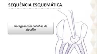 Protocolo Terapia Pulpar com Pasta CTZ [upl. by Oys]