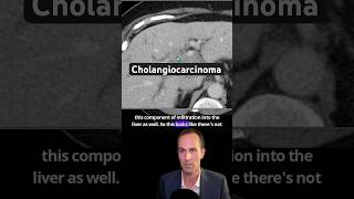 Abdominal CT Tutorials  Cholangiocarcinoma Klastkin [upl. by Bromleigh]