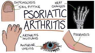 Psoriatic Arthritis [upl. by Alliuqahs]