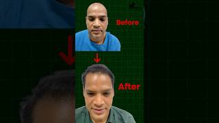 Failed Hair Transplant Repair  Hair Transplant Results I Hair Transplant Bangalore [upl. by Calore790]