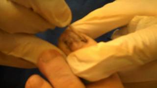 Total Phenol and Alcohol Procedure for a Fungal Toenail 2mp4 [upl. by Juley688]