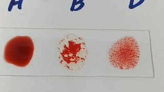 how to perform blood groupblood group ABO blood groupingB positive blood group [upl. by Gant]