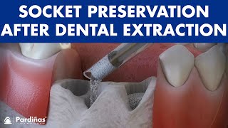 Tooth extraction  Treatment for socket preservation © [upl. by Arahahs]