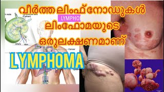 LYMPHOMA മിക്ക ലിംഫോമകളും കീമോതെറാപ്പിയിലൂടെയും ടാർഗെറ്റഡ് തെറാപ്പിയിലൂടെയും സുഖപ്പെടുത്താവുന്നതാണ് [upl. by Lhadnek537]