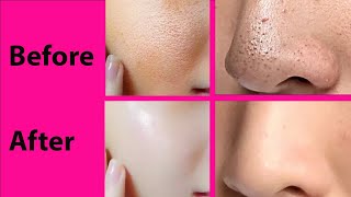 Open Pores treatment at home Full Open Pores Magical Natural Treatment 4 Step Openpores Treatment [upl. by Ioab]