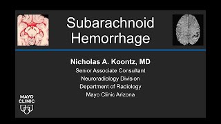 Subarachnoid Hemorrhage [upl. by Yrnehnhoj666]