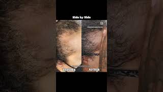 Hair Growth Results After One Week of Microneedling hairlosstreatment alopecia htx houston [upl. by Elockin]