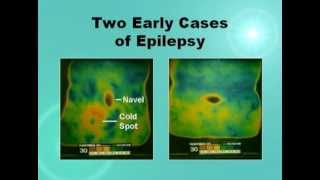 Epilepsy  The Edgar Cayce Approach [upl. by Deering]