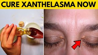 xanthelasma removal at home naturally  remove cholesterol deposits around eyelids [upl. by Atwater]