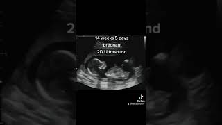 2D Pregnancy Ultrasound at 14 Weeks 5 Days [upl. by Dolhenty]