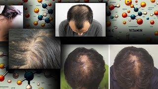 Vitamins and Minerals on Hair Loss Finasteride and Dutasteride [upl. by Cousins]