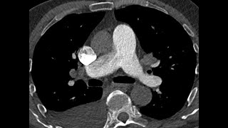 Patent ductus arteriosus may mimics Pulmonary Embolism  CTPA [upl. by Horter]