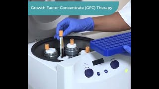 How GFC Prepared  DHI GFC Treatment for Hair Loss [upl. by Intyrb350]