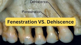 Difference between fenestration and dehiscence with mnemonic [upl. by Phionna]