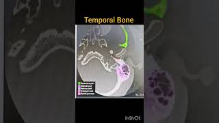 CT temporal Bone anatomy mastoid temporalbone [upl. by Herwin]