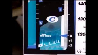 Chest drainage system [upl. by Ahtebbat]