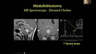 Neuroradiology of Medulloblastomas  Dr Suresh Mukherji MD MBA FACR amp Dr Hemant Parmar MB BS [upl. by Bruyn152]