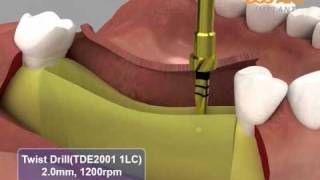 HIOSSEN OSSTEM GSIII GS HG System surgical procedures [upl. by Turne]