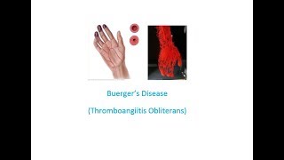 Buergers Disease Thromboangiitis Obliterans Easy Health Exploring [upl. by Weinstock]