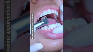 Rimozione apparecchio fisso dai denti  rimozione dei brackets ortodontici [upl. by Latvina320]