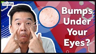 Milia Syringoma Skin Tag amp F Spots Explained [upl. by Aniad]