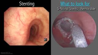 Mastering Bronchoscopy for Thoracic Surgery Chapter 3 [upl. by Nimaynib]