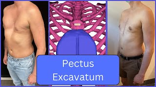 Chest Shape The Ultimate Fix for Pectus Excavatum and Beyond [upl. by Lorenz]