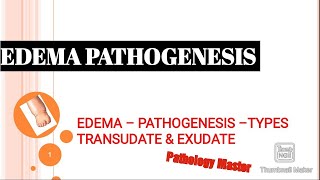 EDEMA  Pathogenesis Of Development [upl. by Grishilda]