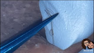 Ingrown Hair Removal Ep28 [upl. by Oiuqise]