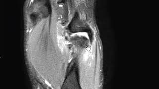 Stener Lesion [upl. by Euqinimod]