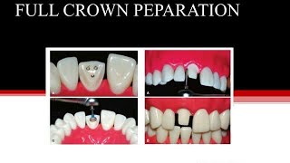 Crown preparationCrown PFM Price in PakistanCrown CementationTooth Crown ProcedureAfterampBefore [upl. by Gazo473]