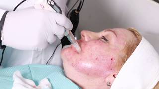 Mesotherapy and dermapen microneedling Before and after Makeover True Reality 22 [upl. by Donia]