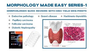 Morphology Series part 1Hashimoto thyroiditisGraves Diseasethyroiditis gravesdiseasemorpholgy [upl. by Izy]