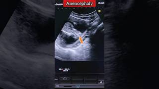 Anomaly Scan Anencephaly ❤️💯 medical anomaly ultrasound pregnancy shorts [upl. by Rooker843]