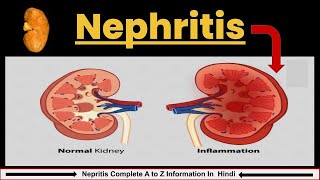 Nephritis in Hindi  Causes Symptoms amp Treatment  Nephrotic Syndrome  Nursing lecture [upl. by Adalia699]