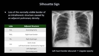 How to Interpret a Chest XRay Lesson 8  Focal Lung Processes [upl. by Polloch]