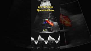 Reversal of portal vein flow radiologyresident medicine doctor radiology radres medschool [upl. by Aynnat]