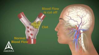 Stroke  3D Medical Animation [upl. by Asusej]