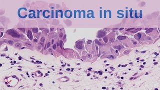 What is Carcinoma in situ  Pathology mini tutorial [upl. by Ayekal]