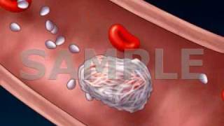 Clot Formation and Clot Breakdown 2D Medical Animation [upl. by Intyre]