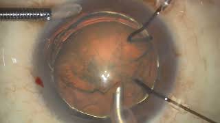 Zonular dialysis in traumatic cataract capsular hook CTR and IOL implant [upl. by Sabir941]