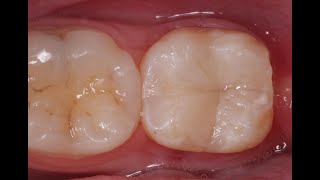 Endo and Direct Composite Restoration [upl. by Aoket]