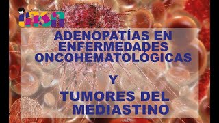 Adenopatías en Enfermedades Oncohematológicas Y Tumores del Mediastino  Telecapacitación INSN [upl. by Yeblehs627]