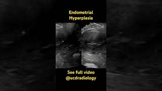 Endometrial hyperplasia  radiology radiologist doctor medicalschool ultrasound [upl. by Kim659]