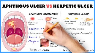 Aphthous ulcer Aphthous stomatitis vs Herpetic ulcer  How to diagnose [upl. by Atiken]